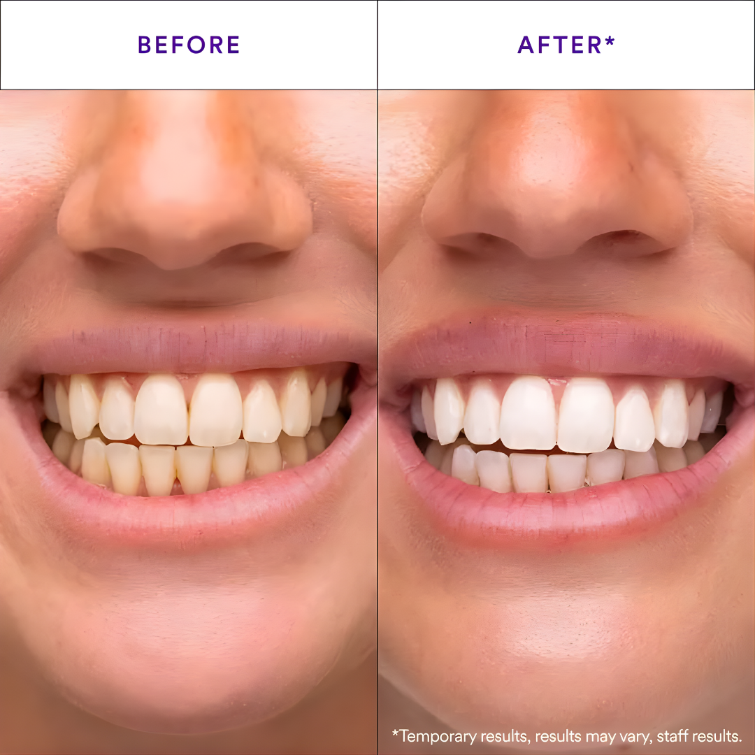 Pearlii™ Teeth Whitening Strips